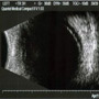 Ultrassonografia-Ocular